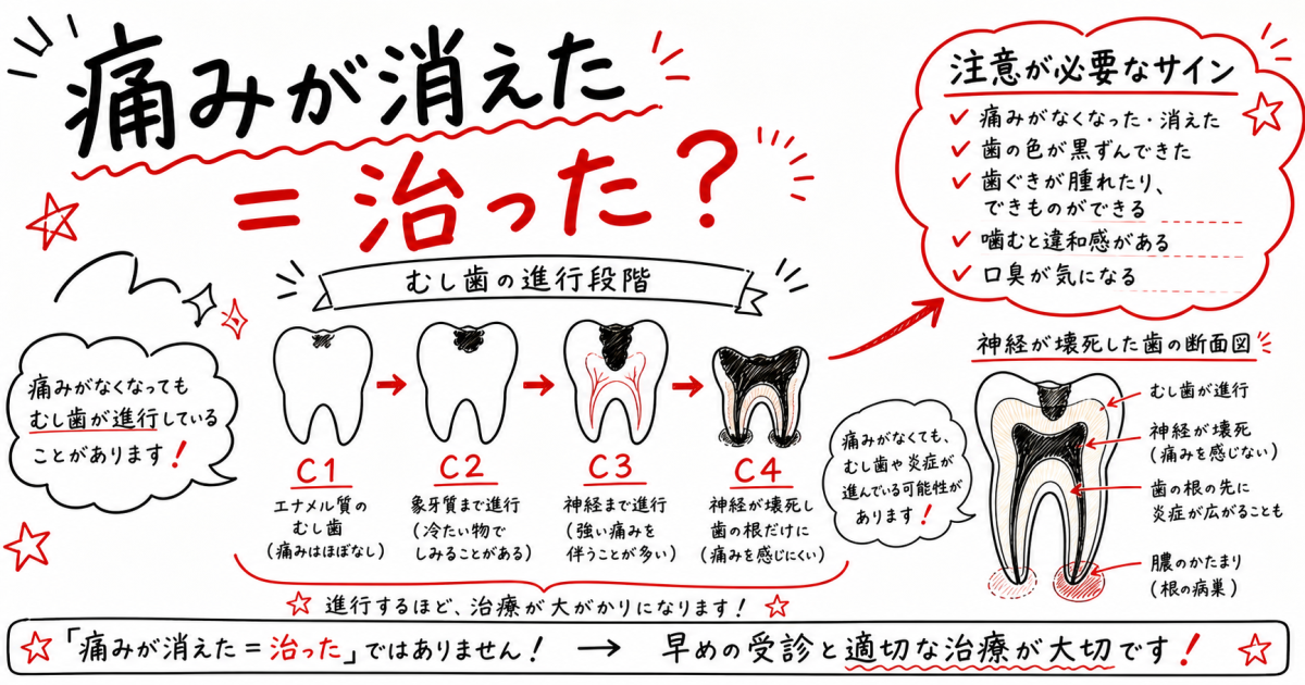 むし歯放置で激痛が消えた?神経の悪化サインと痛みの少ない治療法