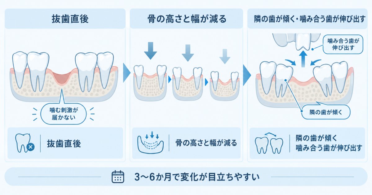 30代40代で歯を失った放置リスクと顎の骨が溶ける影響
